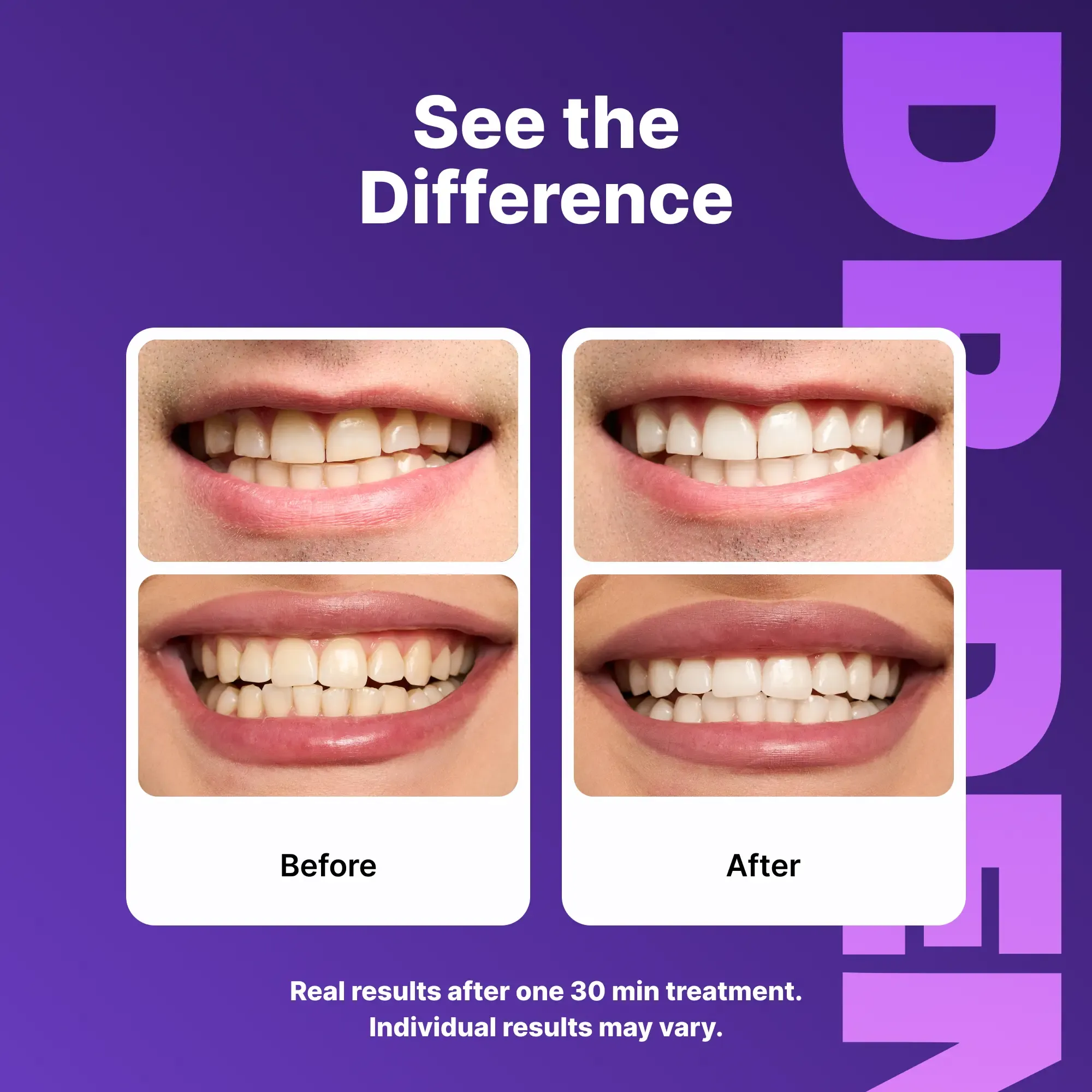 Purple Teeth Whitening Strips - 7/21 Whitening Sessions - Non Sensitive Teeth Whitening - Peroxide-Free