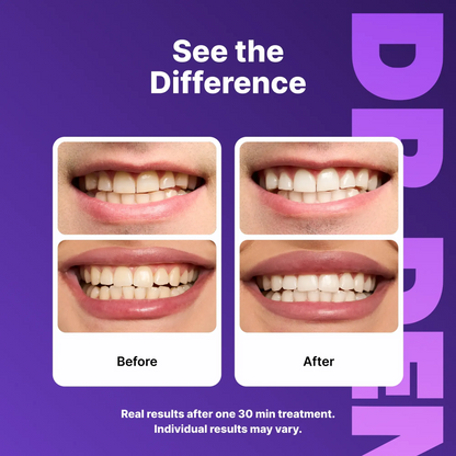 Purple Teeth Whitening Strips - 7/21 Whitening Sessions - Non Sensitive Teeth Whitening - Peroxide-Free
